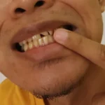 Bahan Alami Atasi Gigi Kuning Loh