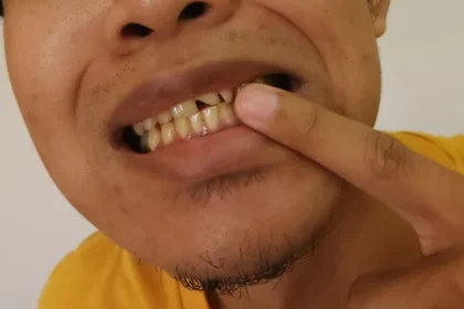 Bahan Alami Atasi Gigi Kuning Loh