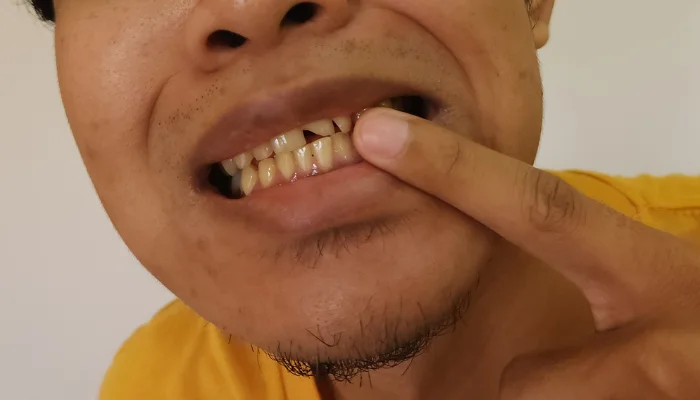Bahan Alami Atasi Gigi Kuning Loh